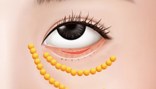 Lower Eyelid Fat Removal (Remove fat in the lower eyelid)