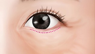 Lower Eyelid/Love Band – Anti-aging Lower Eyelid Surgery (Improving the wrinkles and sagging skin due to aging, fat relocation)