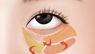 Under Eye Fat Relocation Relocate clumping fats under eye to the hollow areas (removing unnecessary fat)