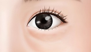 Under Eye Fat Relocation Relocate clumping fats under eye to the hollow areas (removing unnecessary fat)