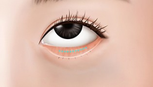 Lower Eyelid Fat Removal (Remove fat in the lower eyelid)