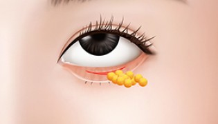 Under Eye Fat Relocation Relocate clumping fats under eye to the hollow areas (removing unnecessary fat)