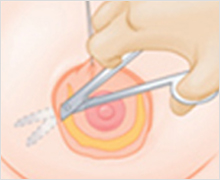 Areola Incision Method