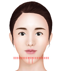 T-shaped osteotomy