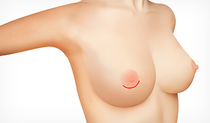 02 Areola Incision Method