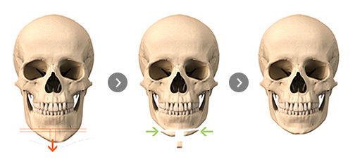 T-shaped osteotomy