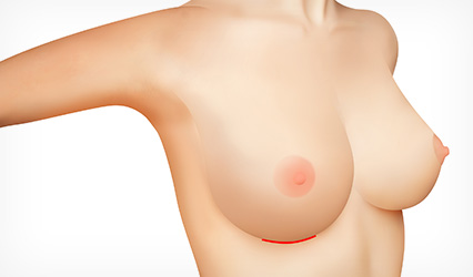 03 Breast Baseline Incision Method