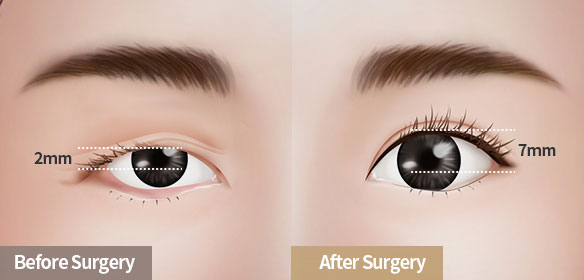 The reason you need Ptosis Correction surgery instead of double eyelid surgery!