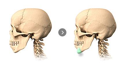 Prosthesis Insertion